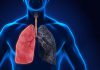 بیماری انسداد مزمن ریوی (COPD) چیست؟