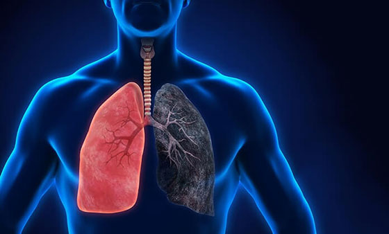بیماری انسداد مزمن ریوی (COPD) چیست؟