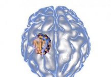 آبسه مغزی چیست؟
