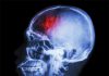 آسیب مغزی تروماتیک چیست؟