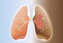 فیبروز ریه چیست؟