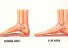 صافی کف پا چیست؟