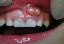 آبسه دندان چیست؟