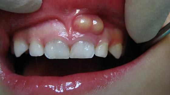 آبسه دندان چیست؟