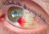 خونریزی چشم چیست؟