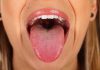 سرطان زبان چیست؟
