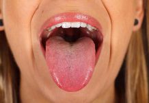 سرطان زبان چیست؟