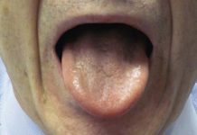 سندرم سوزش دهان چیست؟
