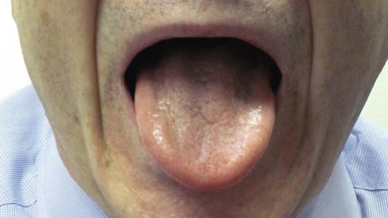 سندرم سوزش دهان چیست؟