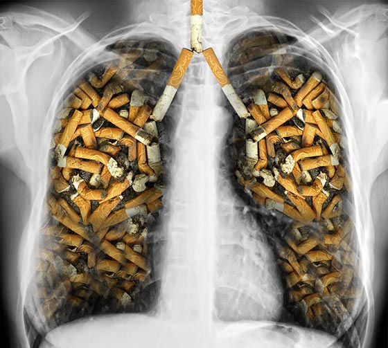 بیماری های ریوی ناشی از سیگار کشیدن