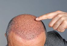 کاشت مو چیست و انواع کاشت مو کدامند؟ کاشت مو چیست؟