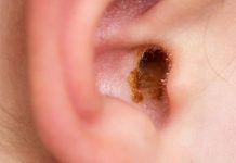 علائم عفونت قارچی گوش